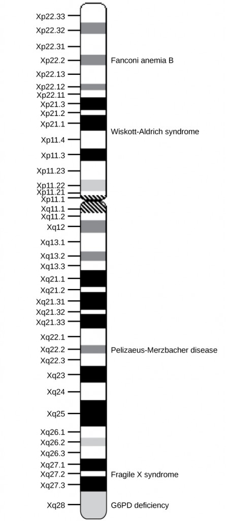 A diagram showing a human chromosome with bands revealed with a Giemsa stain. The bands are labeled with Xp and a number on the short arm and Xq and a number on the long arm. Certain genes are found within some of the bands. These genes are labeled on the right: Fanconi anemia B, Wiskott-Aldrich syndrome, Pelizaeus-Merzbacher disease, Fragile X syndrome, and G6PD deficiency.