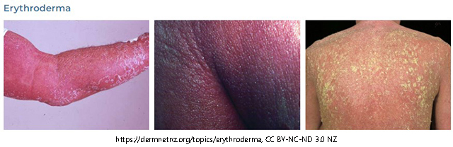 Three images of Erythroderma, which is the term used to describe intense and usually widespread reddening of the skin due to inflammatory skin disease.