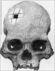 Trepanned skull from an Incan burial site