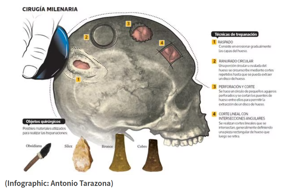 Infographic showing the various techniques of trepanning skulls.