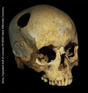 Trepanned skull from an archeological site near Corseaux Switzerland