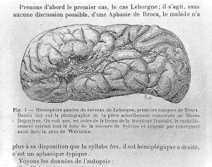 Leborgne's brain obtained at autopsy.