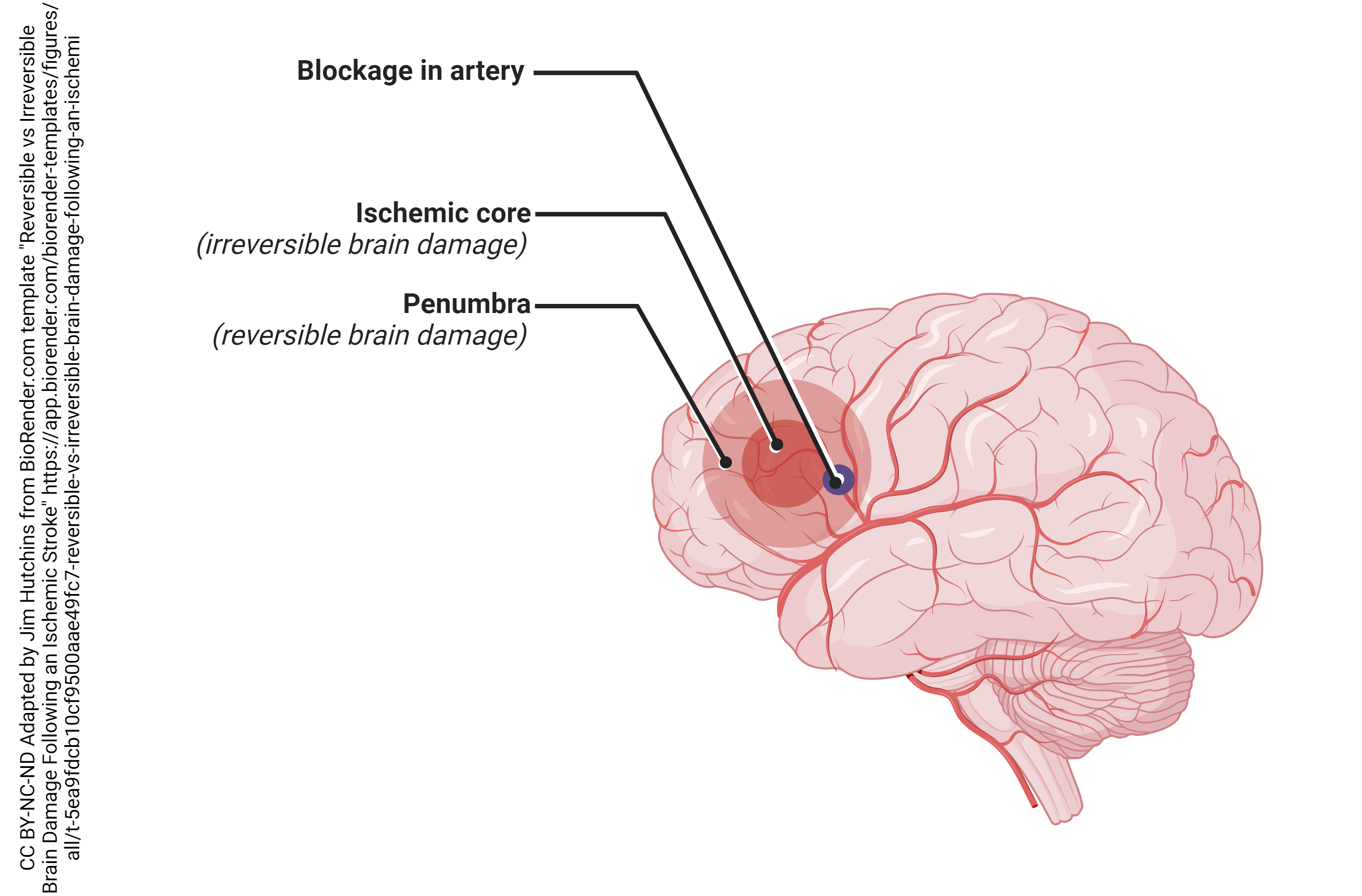 Diagram illustrating the concept of an ischemic core and ischemic penumbra following acute stroke.