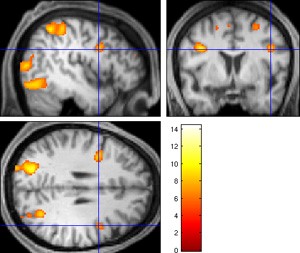 Functional magnetic resonance imaging of a human brain doing mathematical calculations