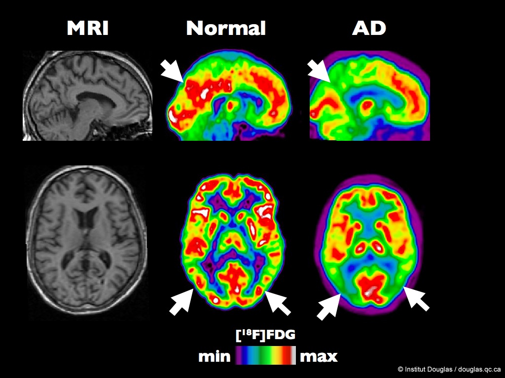 A PET scan of a normal human brain and one in the early stages of Alzheimer disease.