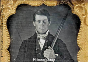 Daguerrotype of Phineas Gage holding the iron rod that went through his head.