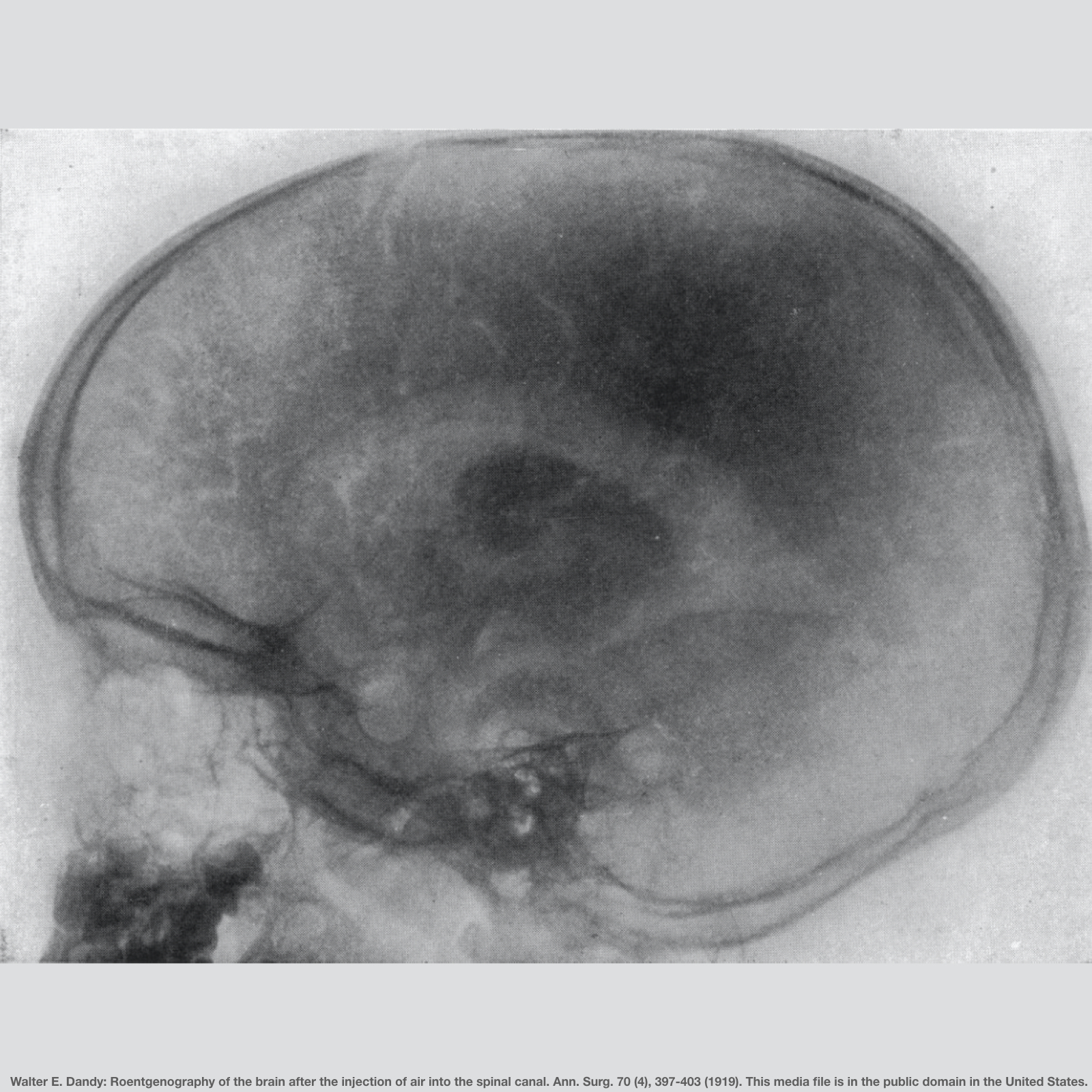 Image by Walter E Dandy, inventor of pneumoencephalography, showing air in the ventricles of the human brain