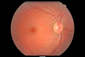 Photograph of the fundus of a human eye.