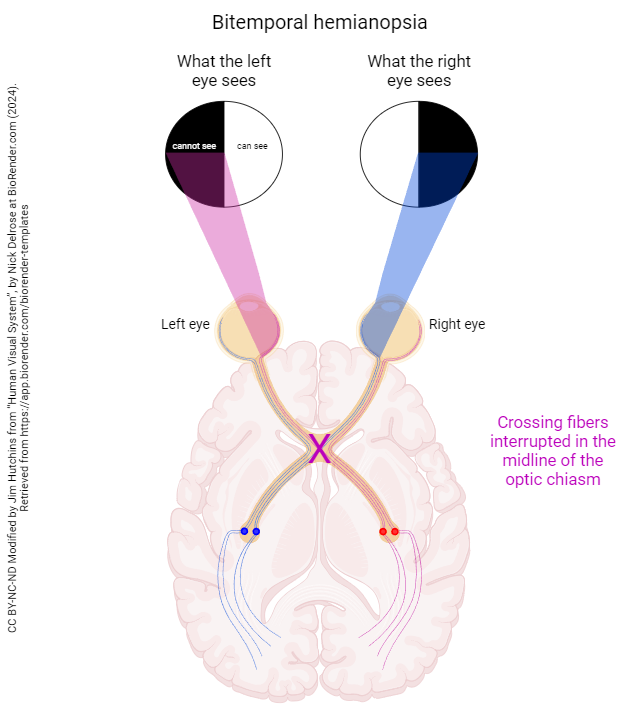 Diagram showing how bitemporal hemianopsia arises.