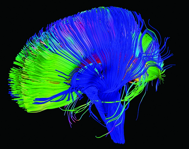 Diffusion tensor imaging shows the axons in the human brain which make up the corona radiata.