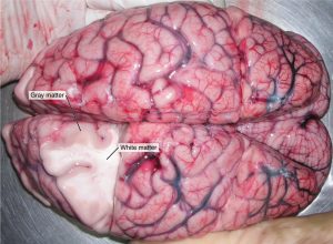 A brain removed during an autopsy, with a partial section removed, shows white matter surrounded by gray matter. Gray matter makes up the outer cortex of the brain.