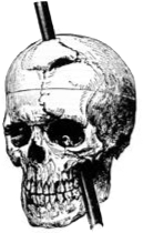 Diagram by Dr John Harlow of the skull of Phineas Gage.