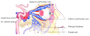 A direct carotid-cavernous sinus fistula resulting in vascular orbital congestion.