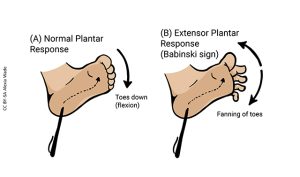 Illustration showing the Babinski Sign.