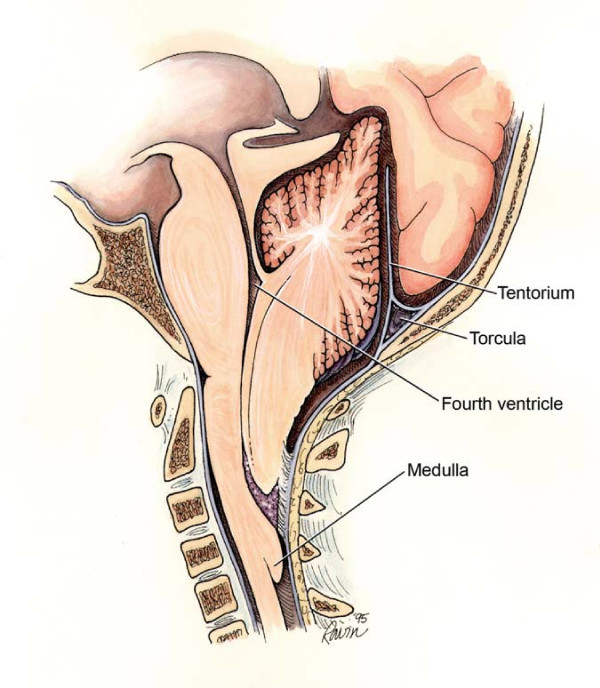 Drawing of a midsagittal section of the head showing the Arnold-Chiari malformation.