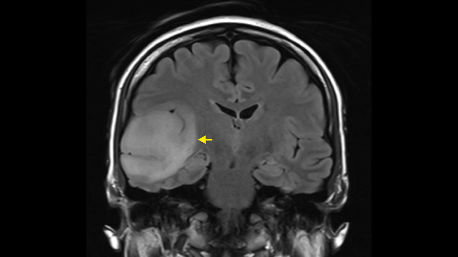 MRI FLAIR image of a central herniation caused by a astrocytoma.