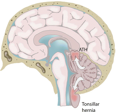 Diagram showing an ascending tentorial herniation and a tonsillar herniation.