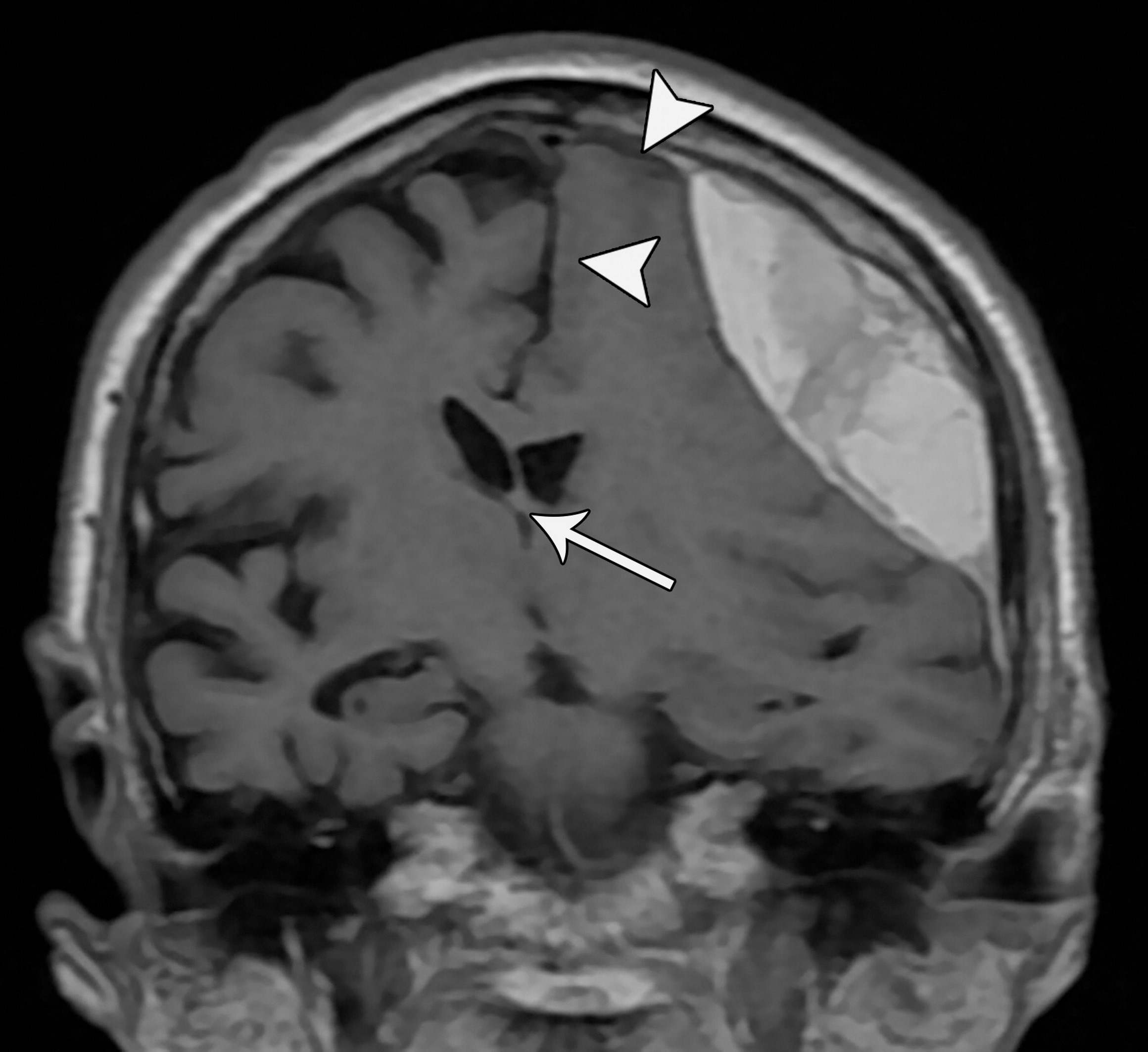 Coronal T1-weighted MRI showing subdural hematoma causing subfalcine herniation.