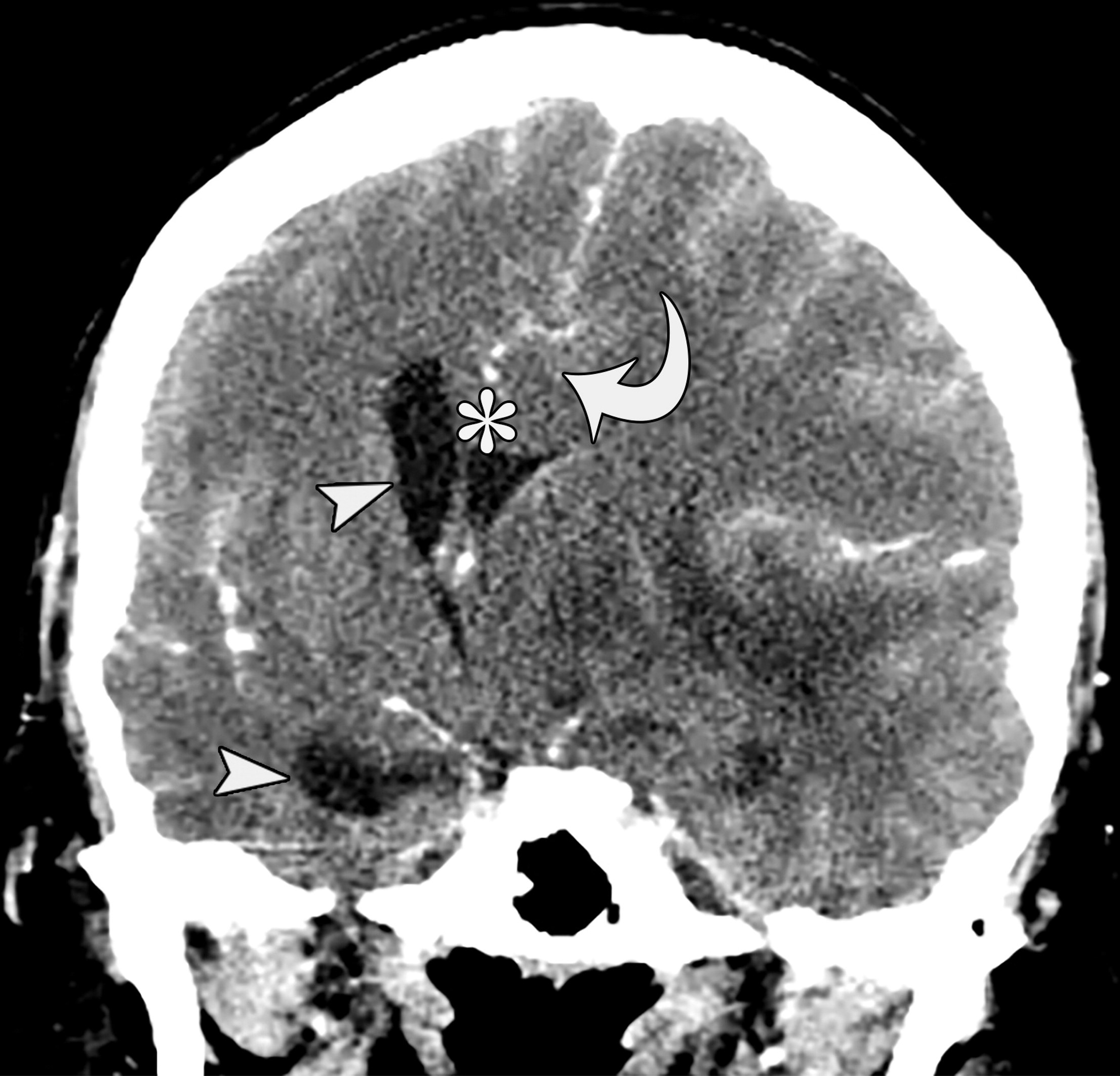 Coronal contrast-enhanced CT image showing herniation of the cingulate gyrus under the falx cerebri.