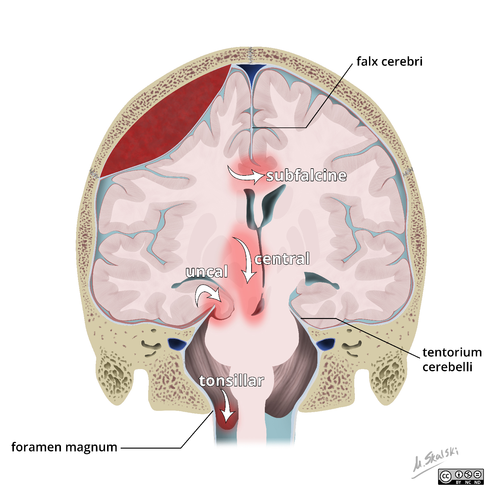 Diagram showing the various types of herniation of the brain.