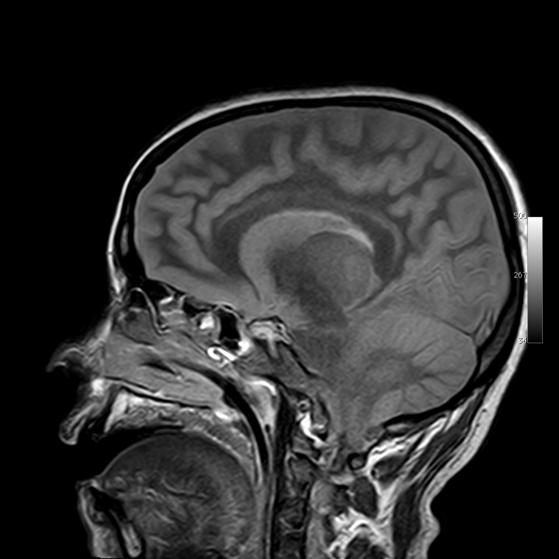 FLAIR image showing tonsillar herniation due to edema.