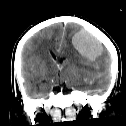 CT scan of a meningioma.