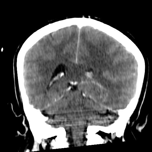 CT scan of a combined subfalcine and uncal herniation.