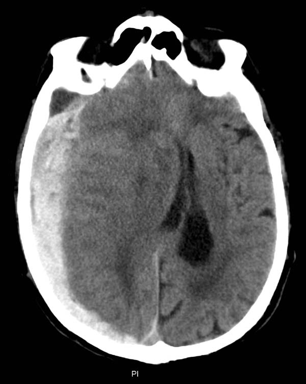 CT image of subdural hematoma causing subfalcine herniation.