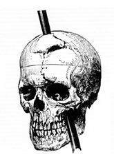 Diagramjof Phineas Gage's skull (Harlow, 1868).