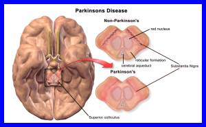 Illustration showing the brain areas involved in Parkinson disease