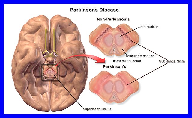 Illustration showing the brain regions of importance in the etiology of Parkinson's disease.