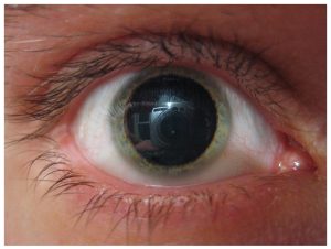 Photograph of a dilated pupil.