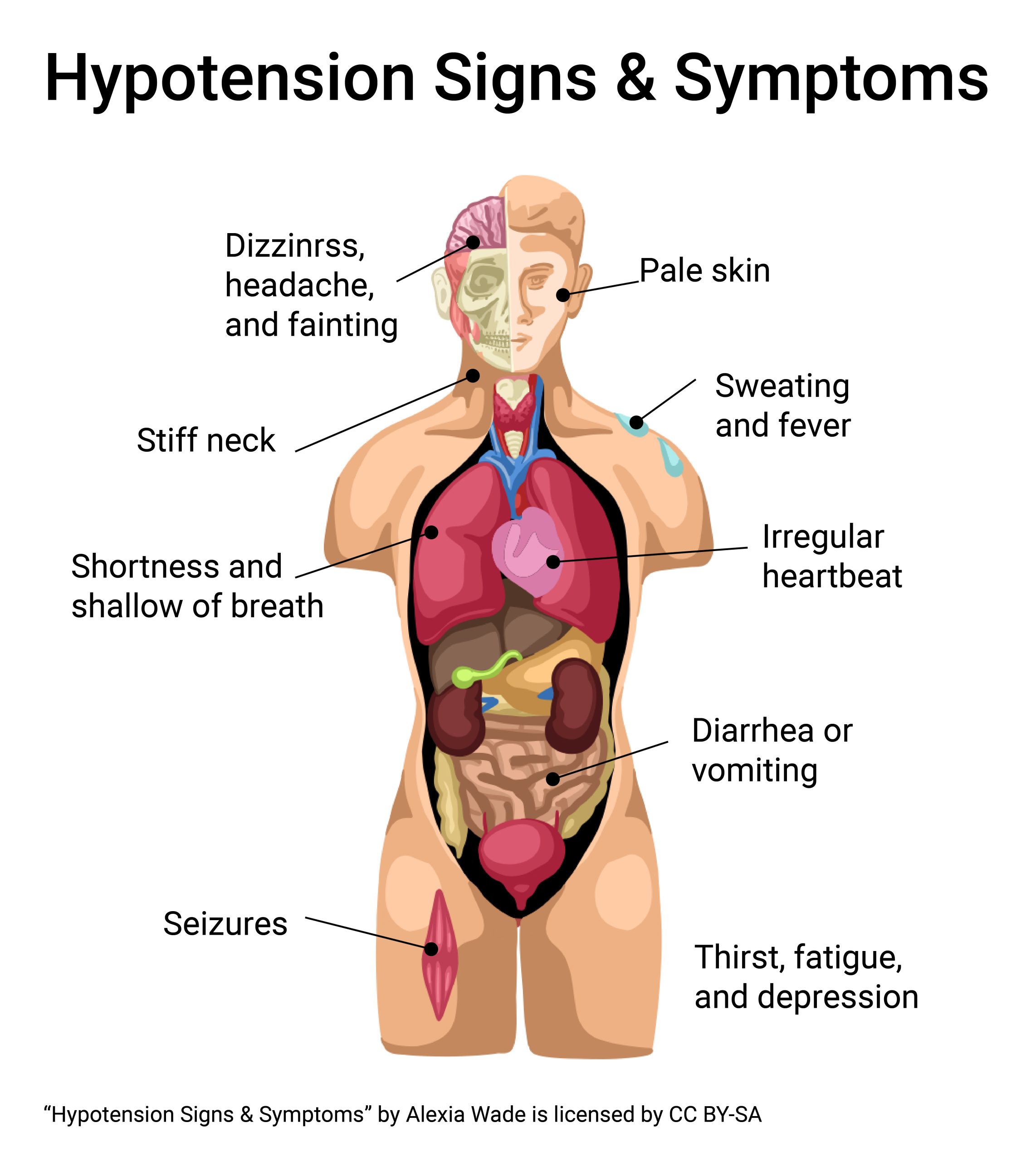 Diagram showing the signs and symptoms of hypotension