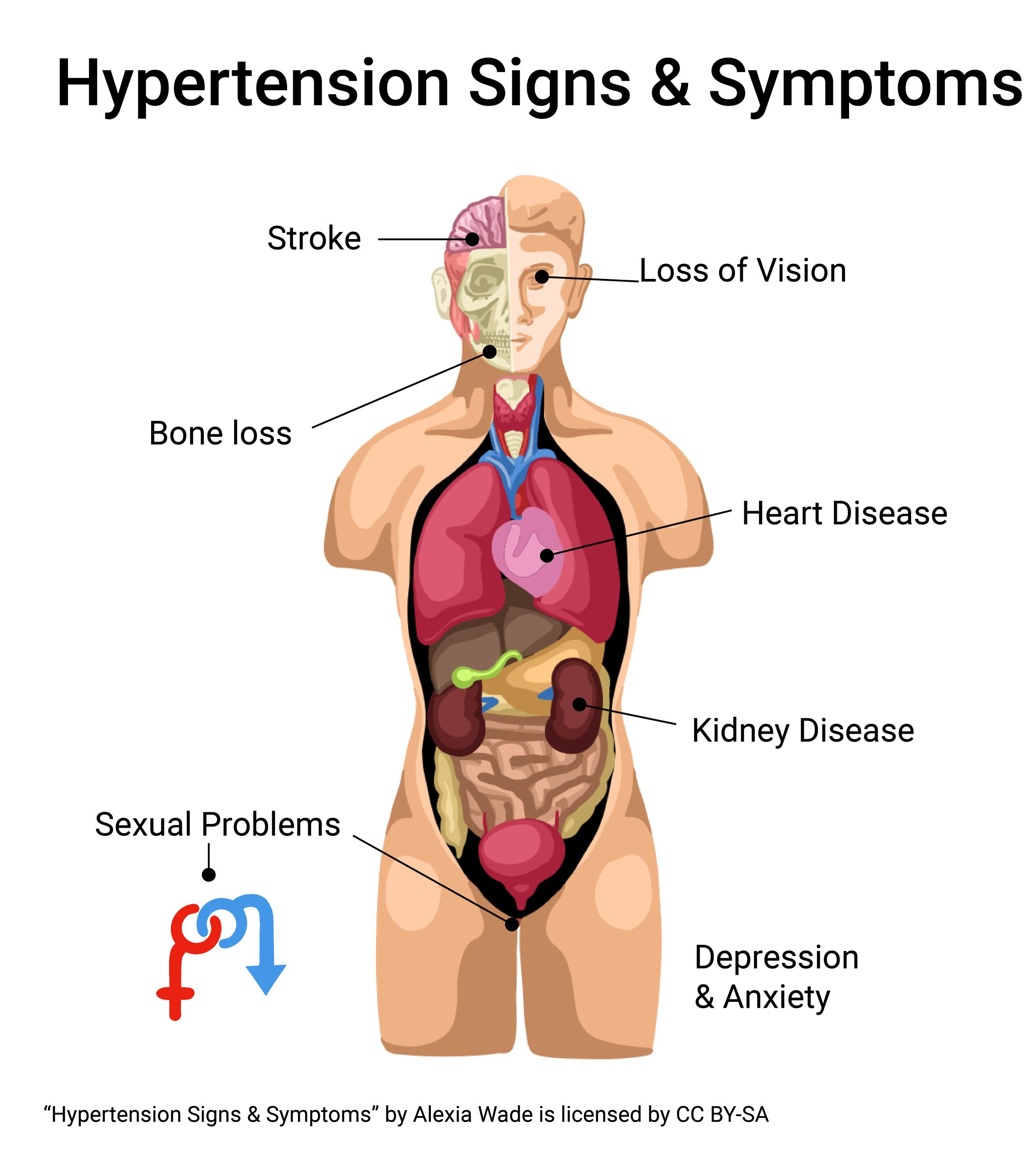 Diagram showing the signs and symptoms of hypertension