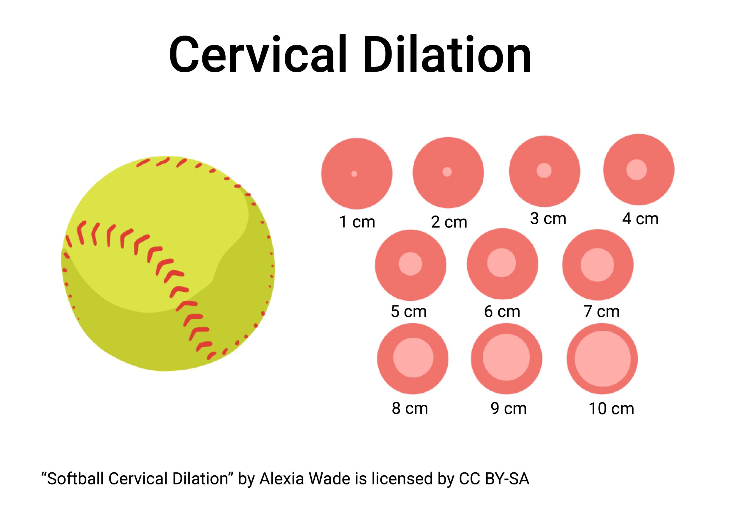 Graphic showing cervical dilation to a softball