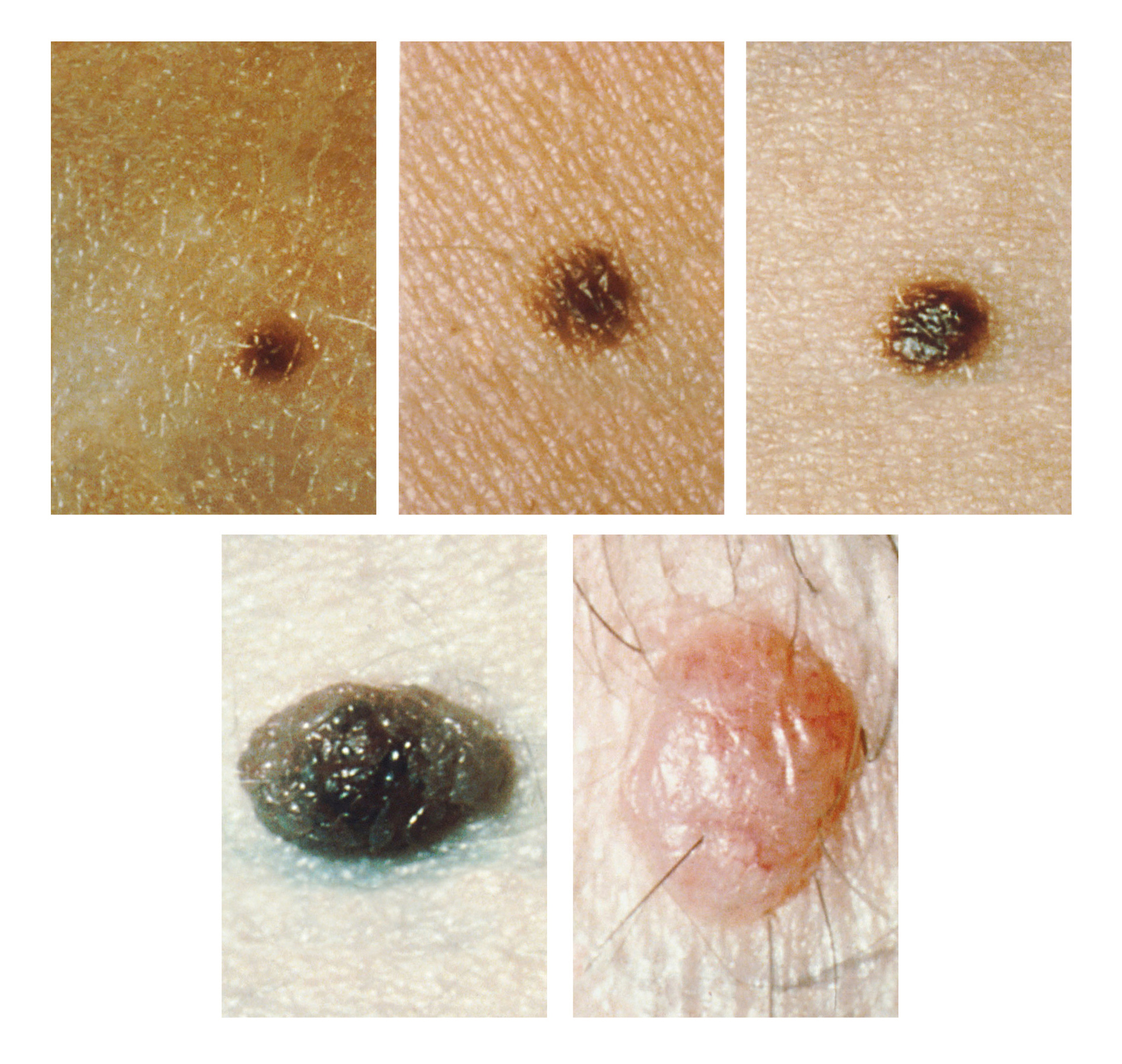 Graphic showing examples of moles.
