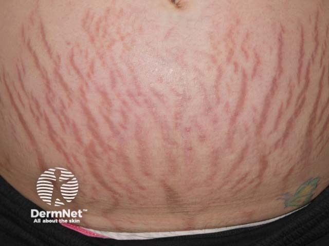 Graphic showing stretch marks in pregnancy.