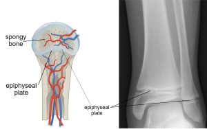 An illustration of an epiphyseal plate along side an x-ray showing the epiphyseal plate.