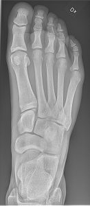 An x-ray of the foot and ankle showing bones.