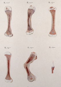 Drawings of cross sections of bones affected by Rickets.