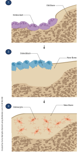 An illustration outlining the process of bone remodeling.