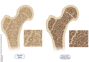 An illustration showing the changes in bone density that occur in osteoporosis compared to normal bone.
