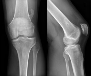 An x-ray of the knee showing the cartilage spaces.