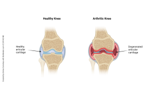 Image comparing a healthy knee and an arthritic knee.