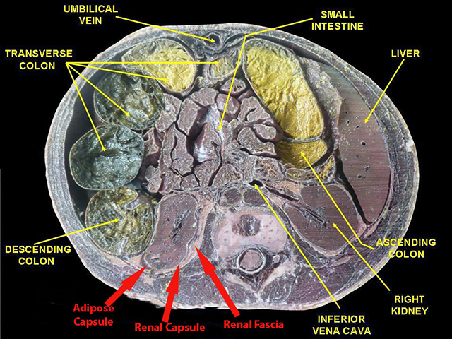 Photograph of a horizontal section of the human abdomen showing the position of the kidneys with the associated connective tissues labeled.