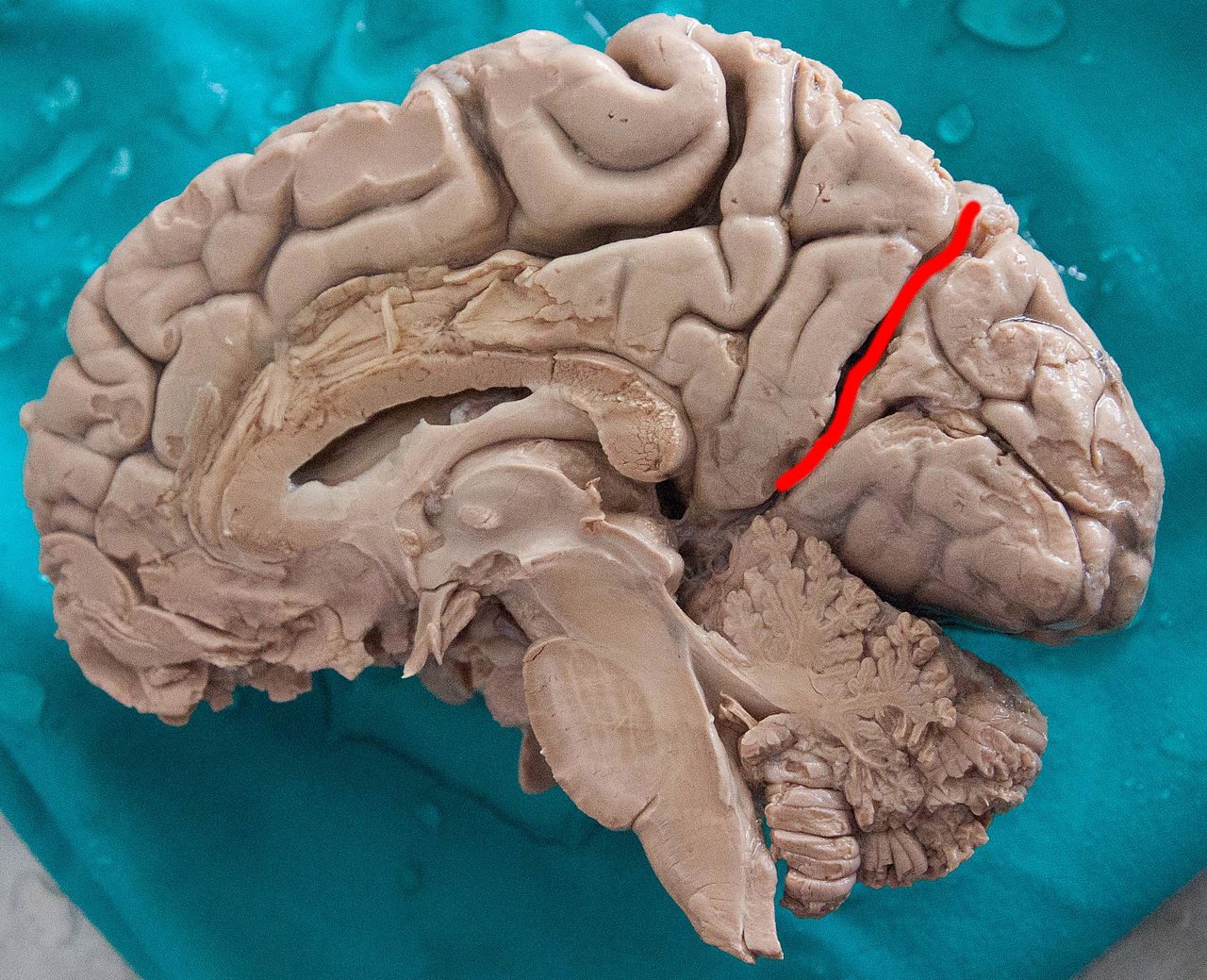 Human brain dissected parieto-occipital sulcus highlighted.