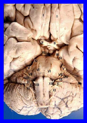 Photograph of the inferior surface of the human brain with cranial nerves numbered.