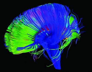 Diffusion tensor imaging shows the axons in the human brain which make up the corona radiata