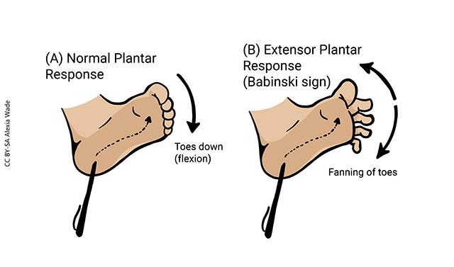 Illustration showing the Babinski Sign.