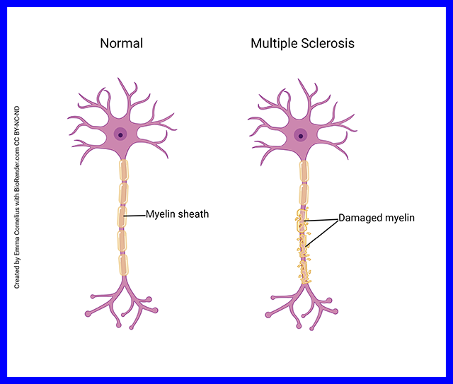 Diagram showing the damaged myelin sheath in the disease multiple sclerosis.